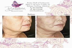 Tarik Benang (Threadlift)